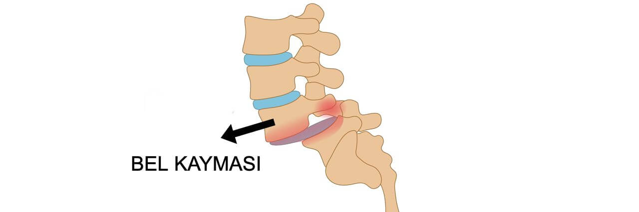 Bel Kayması Türleri ve Tedavi Yöntemleri