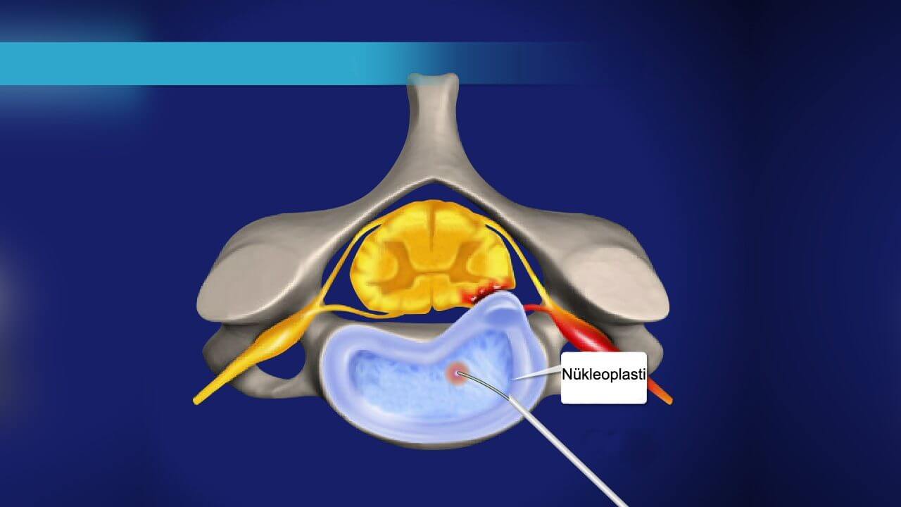 Boyun Fıtığı Tedavi Yöntemleri