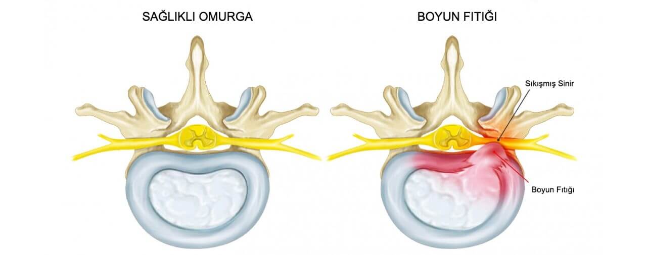 Boyun Fıtığı - Boyun Ağrısı