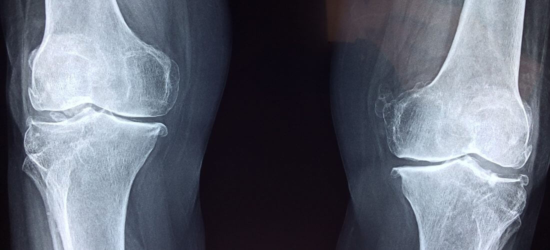 Osteoporoz, Omurga Ağrısı, Bel Kırığı