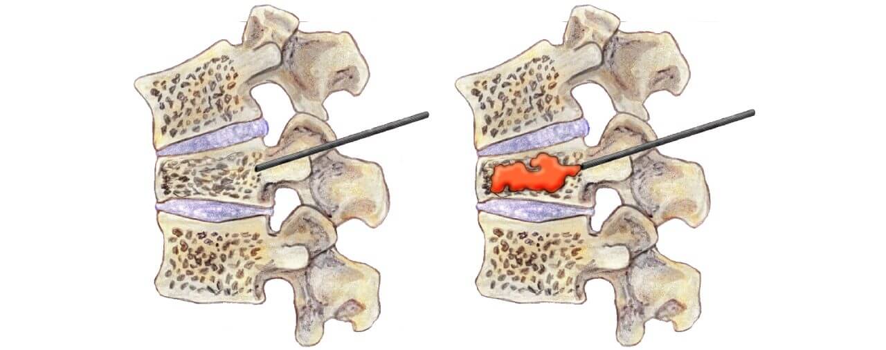 Vertebroplasti - Kifoplasti İşlemleri Uygulama