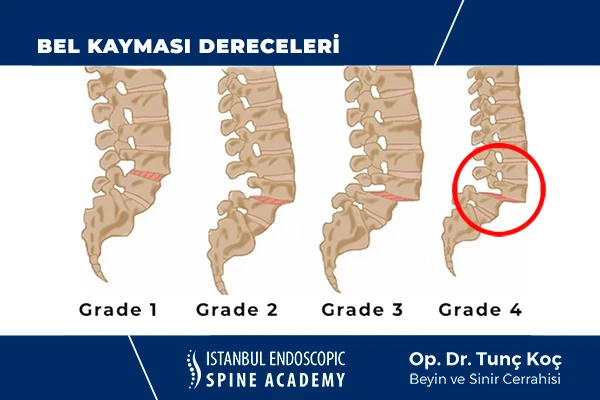 Bel Kayması Dereceleri