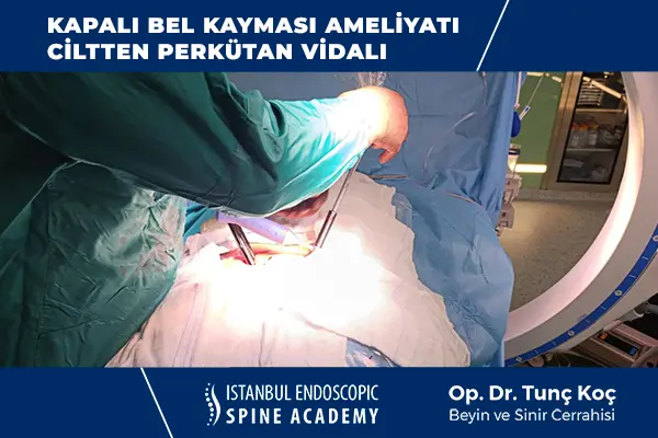 Bel Kayması Perkütan Vida Sistemi