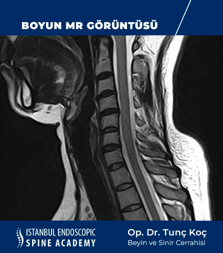 Boyun MR Görüntüsü