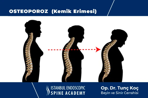 Osteoporozun Omurga Üzerindeki Etkileri