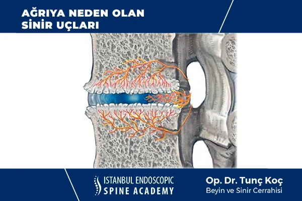 Kameralı Nükleoplasti Ağrı Bölgesi Tedavisi