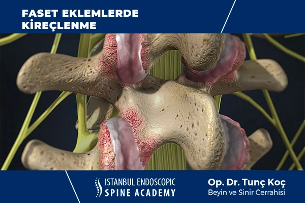 Faset Eklem Kireçlenmesi