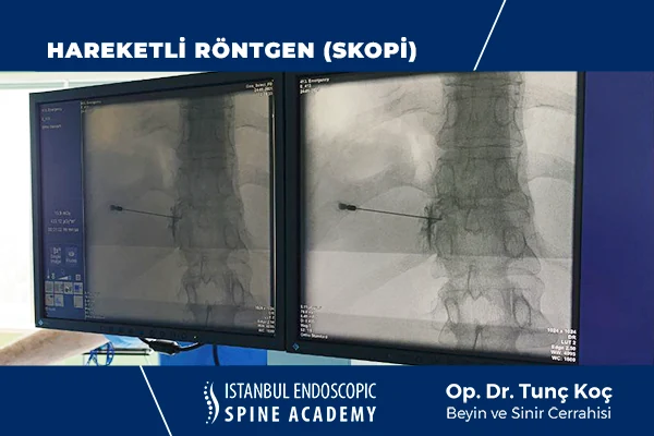 Kireçlenme Tedavisi Radyasyon Güvenliği