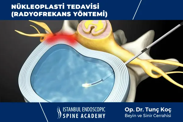 Nükleoplasti Radyofrekans Yöntemi