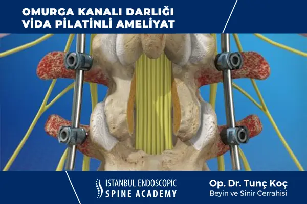 Omurilik Kanalı Darlığı Vida