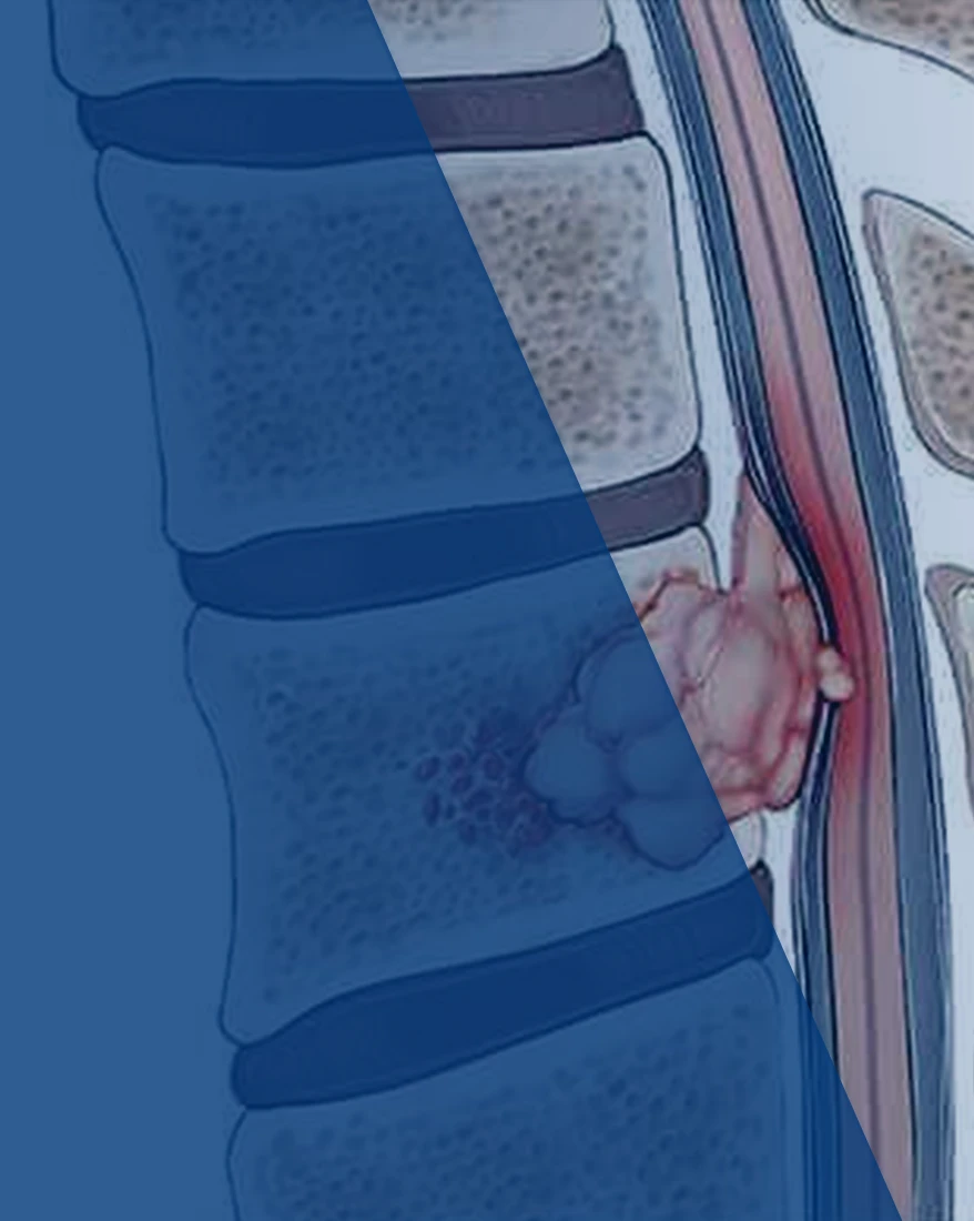 Op. Dr. Tunç Koç - Omurilik Tümörleri
