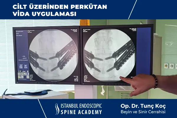 Perkütan Vida Nasıl Takılır