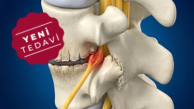 Yeni Kameralı Kireçlenme Tedavisi
